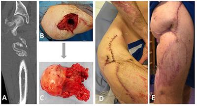 Use of Phage Cocktail BFC 1.10 in Combination With Ceftazidime-Avibactam in the Treatment of Multidrug-Resistant Pseudomonas aeruginosa Femur Osteomyelitis—A Case Report